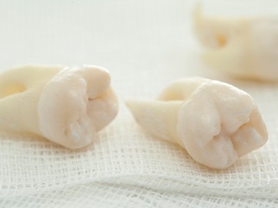 智齒疼了，這牙非拔不可嗎？