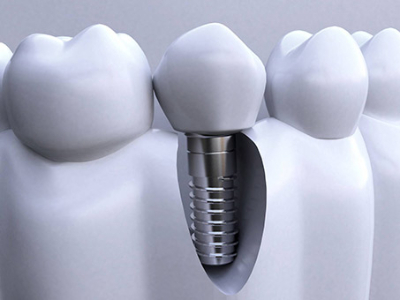 承德種植牙價格表，2024種植牙多少錢一顆呢?