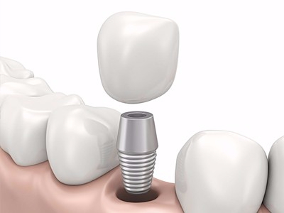 在承德哪家口腔醫(yī)院口腔種植齒好一點，惟德口腔醫(yī)院值得您的選擇