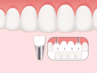 惟德口腔口腔種植怎么樣？惟德口腔就來為您一一解答