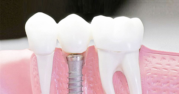 在承德口腔種植牙齒需要多少錢(qián)？惟德口腔一一為您道來(lái)